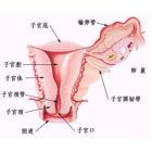 子宮切除術後會陰疝 子宮切除後盆底疝