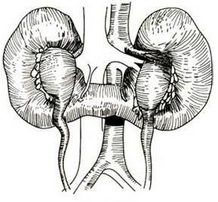 馬蹄形腎 Q63.101 蹄鐵形腎 蹄鐵腎 馬蹄腎