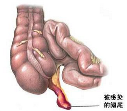 腎動脈閉塞 Renal artery occlusion