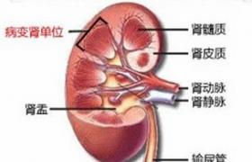 成人多囊腎 Adult polycystic kidney disease