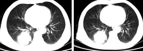 肺動靜脈瘺 I28.001 先天性肺血管畸形 肺血管擴張癥 毛細血管擴張癥伴肺動脈瘤 遺傳性出血性毛細血管擴張癥 Rendu-Osler-Weber病 肺動靜脈瘤