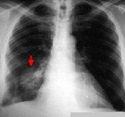 肺動脈發育不全