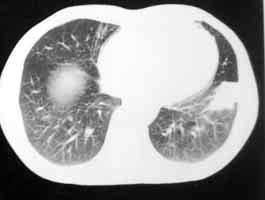 肺炎性假瘤 J98.409 肺內良性腫塊