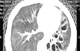 先天性肺囊腫 Q33.001 肺囊腫