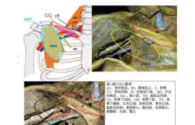 胸廓出口綜合征 G54.003 度外展綜合征肋鎖綜合征前斜角肌綜合征