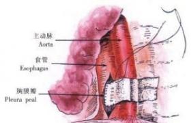 異物性食管穿孔