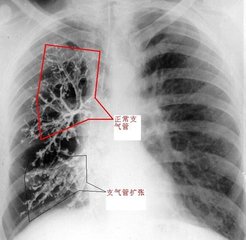 支氣管發育不全 支氣管肺發育不良 支氣管肺發育異常