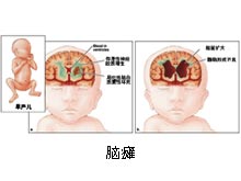 腦癱 腦性癱瘓 小兒腦性癱瘓