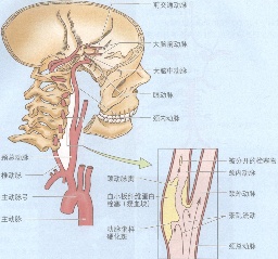 腦梗死 腦梗塞