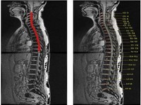 脊髓損傷 T09.302 Spinal cord injury
