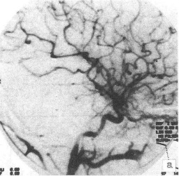 腦血管畸形 Q28.301 先天性腦血管發育異常 非真性腫瘤 血管瘤