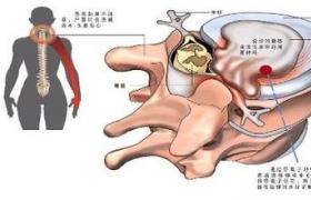 頸椎椎管狹窄