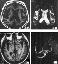 賓斯旺格病 賓斯旺格氏病 動脈硬化性皮層下腦病 進行性白質腦病 皮質下動脈硬化性腦病