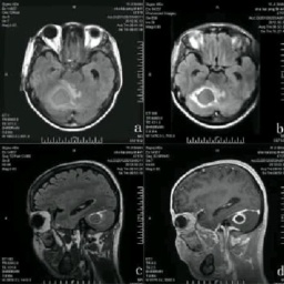 化膿性腦膜炎 G00.901 化腦