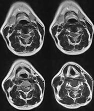 脊髓神經鞘瘤 D32.151 脊髓神經纖維瘤 脊髓許旺氏細胞瘤