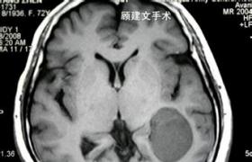 腦室內腦膜瘤