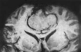 小腦腦橋角腦膜瘤