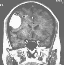 鞍結節腦膜瘤 D32.003