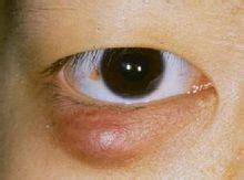 眼瞼炭疽 覆杯 眼瞼瘡瘍