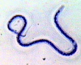 盤尾絲蟲病 B73.X53+ 河盲癥 旋盤尾線蟲病 致盲絲蟲病