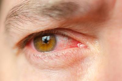淋病感染到眼睛癥狀有哪些