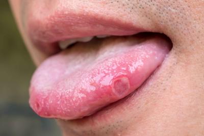 尖銳濕疣可能長在舌頭上嗎