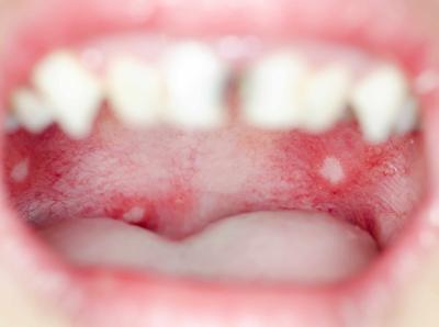 口腔淋病感染有什麼癥狀