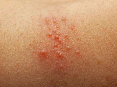 生殖皰疹反復發作影響生命嗎