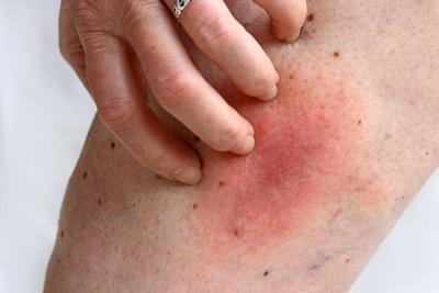皮膚上有疹子癢不發燒是艾滋病嗎