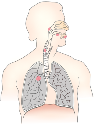 艾滋病反流性咽炎的癥狀是什麼癥狀  介紹反流性咽炎的主要表現和治療方法