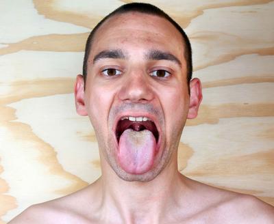男性艾滋病初期舌頭癥狀表現有哪些