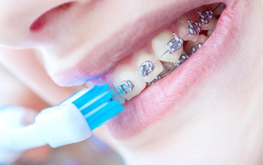 戴牙套可以用電動牙刷嗎