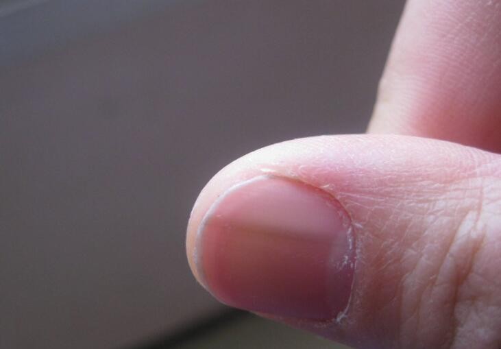 指甲為什麼會有豎紋