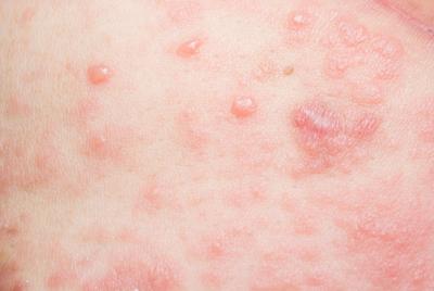 介紹生殖器皰疹有哪些常見的癥狀